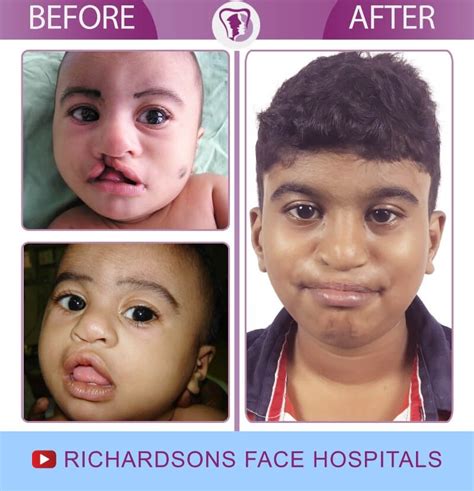 Cleft Lip and Palate Surgery - Richardson's Plastic Surgery Hospitals