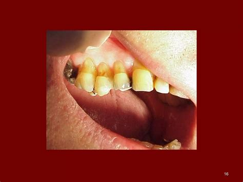 07.non carious lesions | PPT