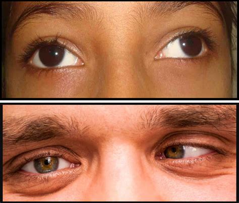 squint clinic  trivandrum treatment  squint  oculomotor