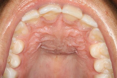 Nasopalatine Duct Cyst Causes Symptoms Diagnosis Trea - vrogue.co