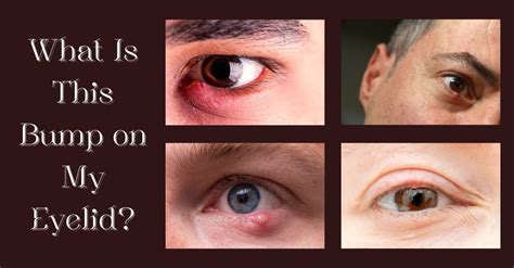 bump   eyelid eye care center