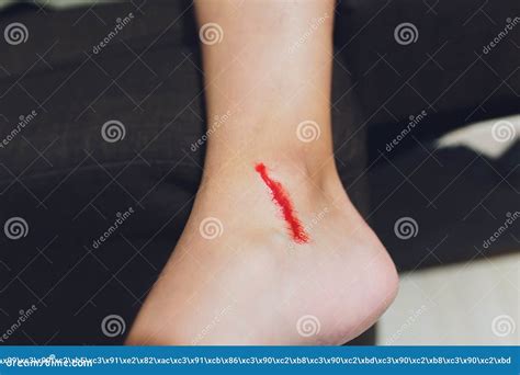 The Leg is Wound with Bleeding Caused by Scratching. Stock Photo ...