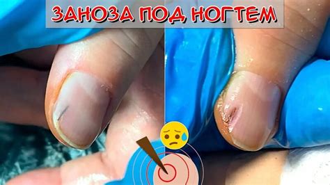 Заноза под ногтем как достать? / Вытаскиваем большую занозу - Смотреть ...