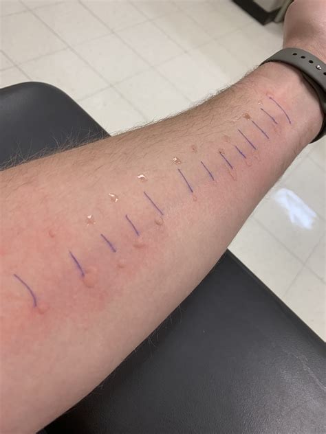 I had my first allergy test today… : r/Wellthatsucks