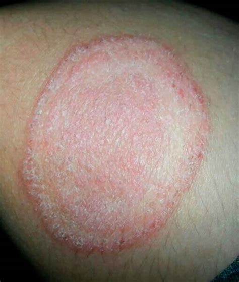 Tinea Versicolor Description at James Jiles blog