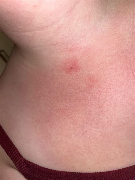 Redness around mole? : r/DermatologyQuestions
