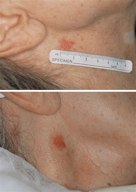 Treating Basal And Squamous Cell Skin Cancer – FYVISM