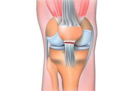 Quadriceps Tendon Rupture Repair | Knee Surgery Specialist | Dr Satish