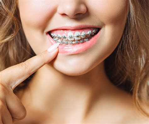 Braces | LightForce 3D Braces Provider | Smile Health Orthodontics
