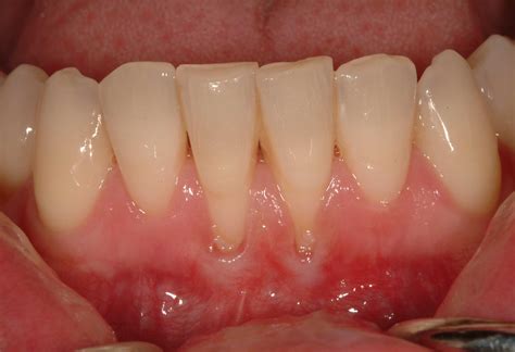 Gingivitis Gum Recession at Christy Sample blog