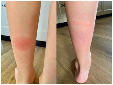 Multiple Erythema Migrans