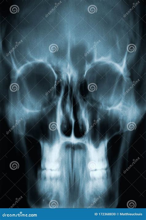 Human Adult Male Skull X-ray Image or Radiography. Medical Imagery ...