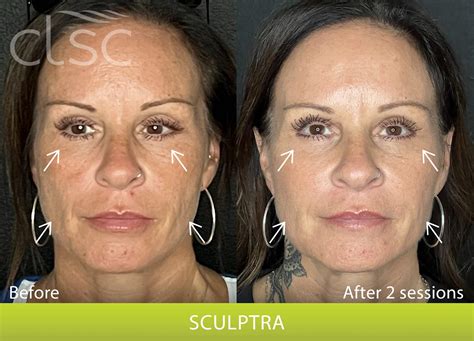 Sculptra - Before & After | Columbia Laser Skin Center
