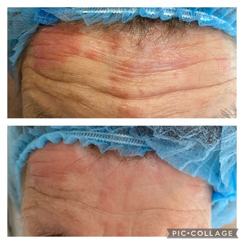 Dr Platon Cold Plasma Therapy - London & Surrey Aesthetics