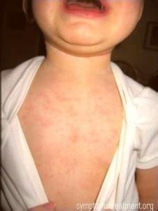 Roseola rash- Pictures, Photos, Symptoms, Treatment