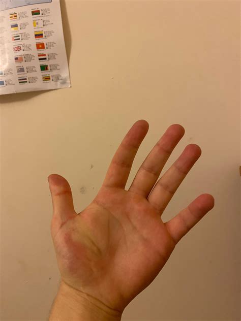 INJURY - if you can see the base of my thumb has some muscle problem