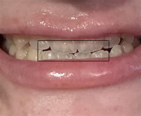 bottom   teeth turning clear  roberto stiefel blog