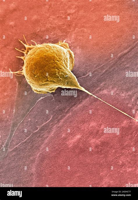 bladder cancer cell coloured scanning electron micrograph sem