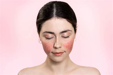 Anti redness skincare: 14 Best Products for Rosacea - UK