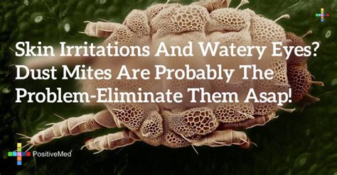 Skin Irritations and Watery Eyes? Dust Mites are Probably the Problem ...