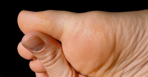 hallux rigidus nashville tn orthopedic surgery