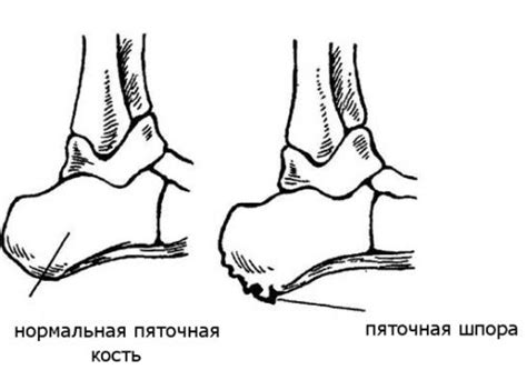 Пяткашпор — инструкция по применению, цена и отзывы