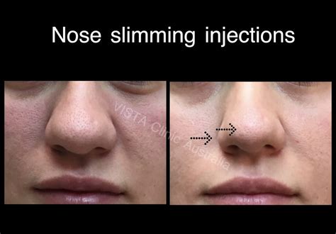 bulbous nose concerns vista clinic australia