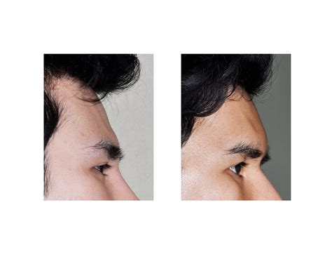 Male Forehead Augmentation Indianapolis Dr Barry Eppley - Explore