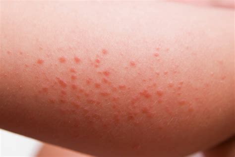 Celiac Disease Rash (Dermatitis Herpetiformis) Explained - Good For You ...