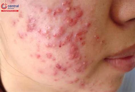 thong tin  biet nguyen nhan va cach dieu tri nhot