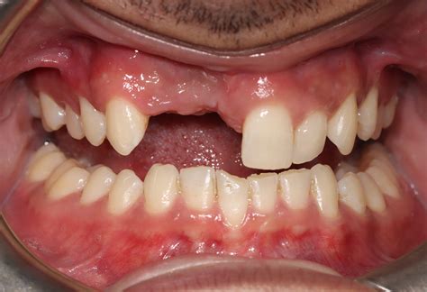 Bone grafting procedure using MinerOss allograft material