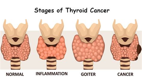 Thyroid Cancer Archives - Oncoplus Hospital