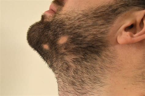 Alopecia barbae: How to get rid of bald patches in beards - MBman