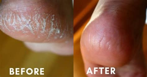 how to fix a cracked heel