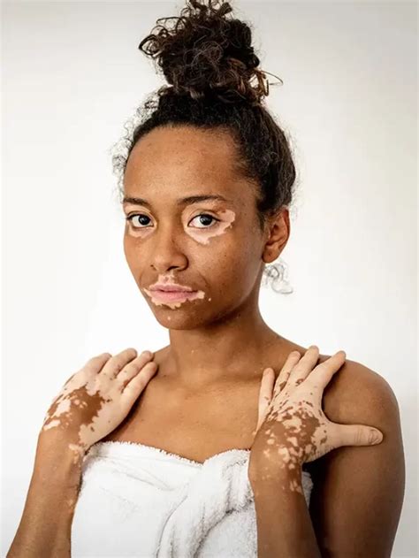 how to cure vitiligo at home
