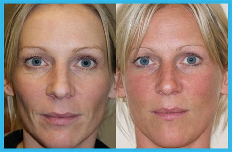 Injectable Collagen Stimulating Treatment – Saphira Clinic