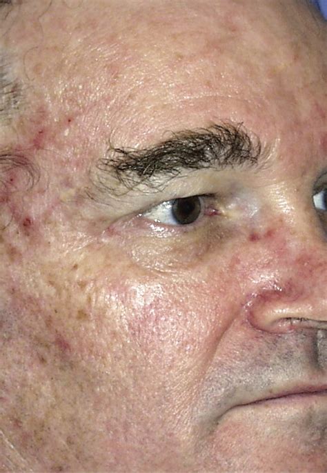 reverse years  sun damage   face jiva med spa