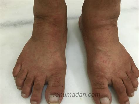 chikungunya rash and swollen left ankle – Dr Renu Madan