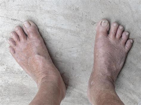 Swollen Feet Stock Photos, Images and Backgrounds for Free Download
