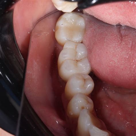Циркониевая коронка на имплантанте - dentalhit