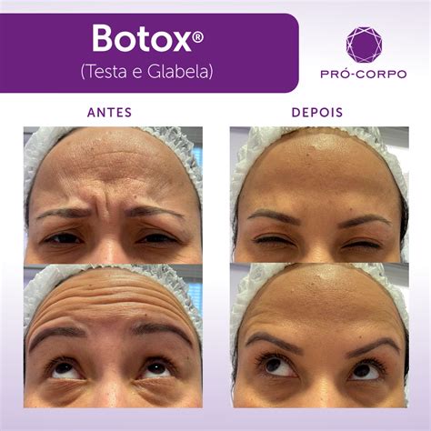 Valor Botox Testa E Olhos - Botox: Toxina botulínica para rugas e linhas de expressão