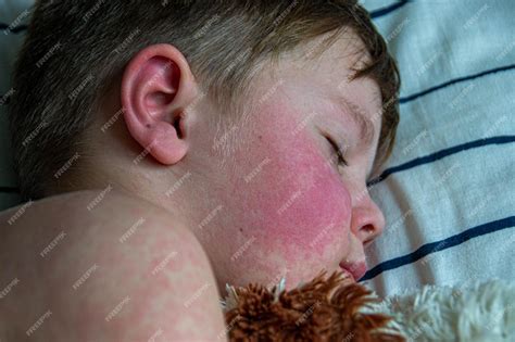 premium photo viral disease measles rash   body   child allergy