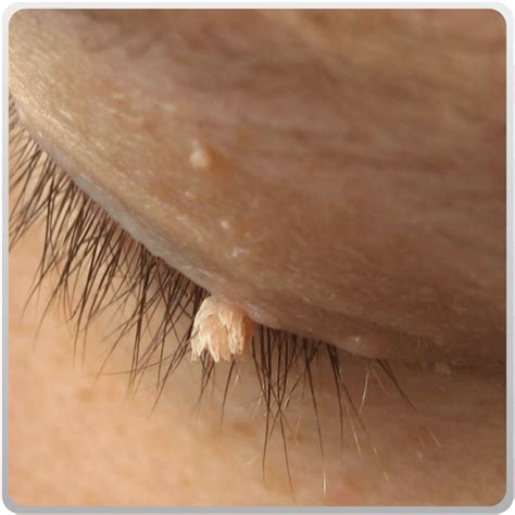Benign skin growth/skin tag - Ko Skin Specialist