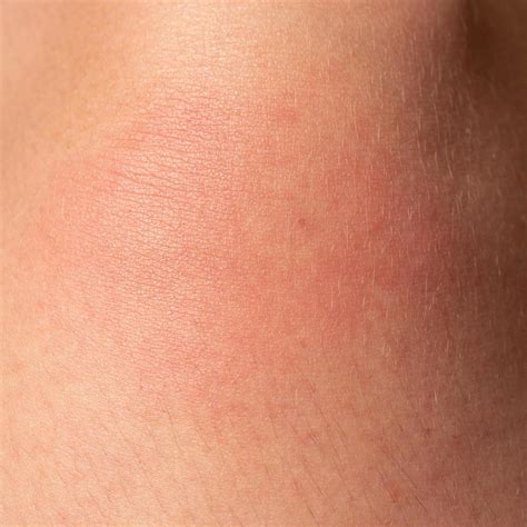 allergie sur le corps humain et rougeur d'une piqûre de guêpe. 14377763