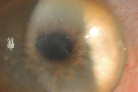 anterior basement membrane dystrophy icd  openbasement