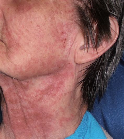 Rash From Liver Disease at Ruben Ramos blog