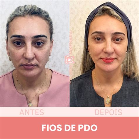 Fios De Pdo Prós E Contras - Dra. Lúcia Takenaka | Harmonização Facial em Contagem — Fios de PDO ...