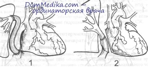 Двунаправленный (бипульмональный) кавапульмональный анастомоз ...