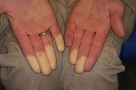 Raynaud's syndrome: symptoms, causes and treatment