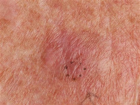 Lichenoide Keratose
